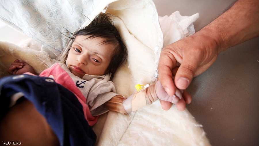 أطفال اليمن يواجهون الموت جوعا