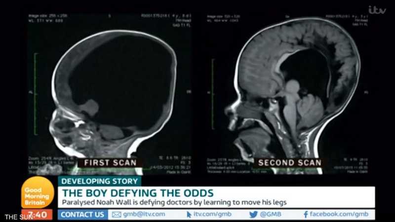صورة مسح لدماغ الطفل تظهر نمو الدماغ