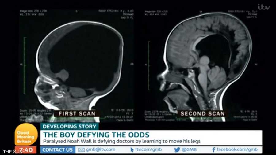 صورة مسح لدماغ الطفل تظهر نمو الدماغ