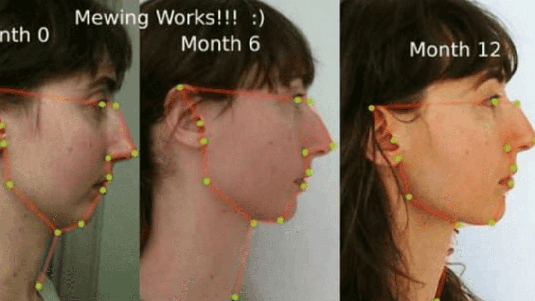 تقنية لتغيير شكل الوجه بواسطة اللسان
