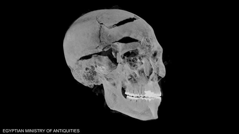 الأشعة توضح كسورا في جمجمة الملك المصري