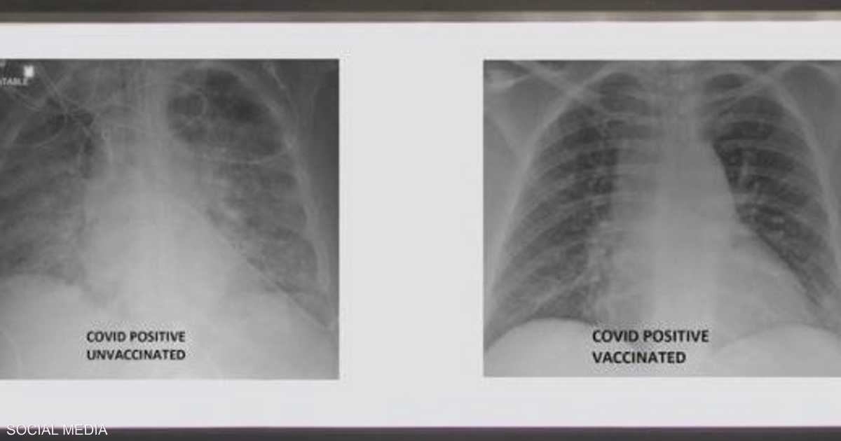 Covid-19 فيروس كورونا يؤثر على الجهاز التنفسي وتحديداً على الشعب الهوائية
